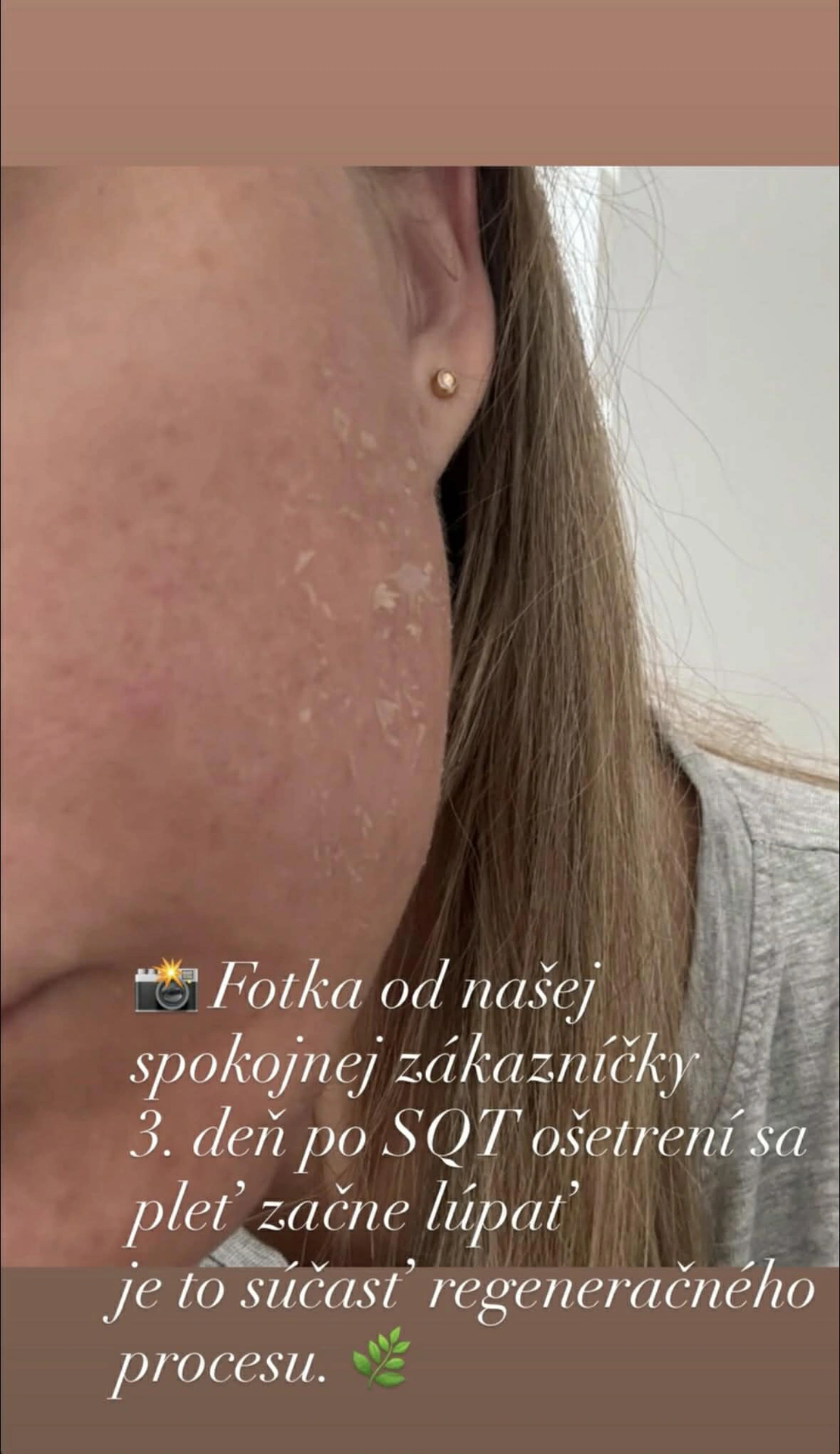 Peeling 3